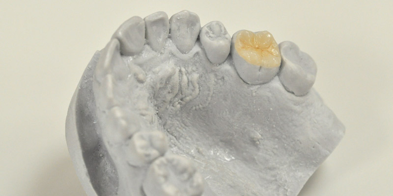 Composite crowns, inlays, onlays