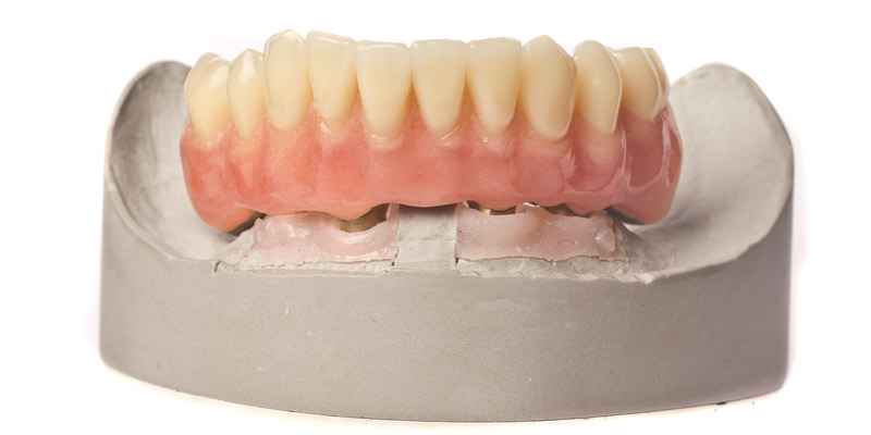 Implant bridge