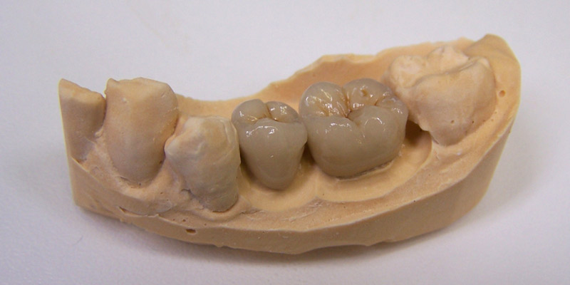 Porcelain bonded crown