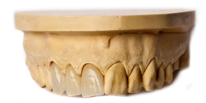 Zirconia bridge