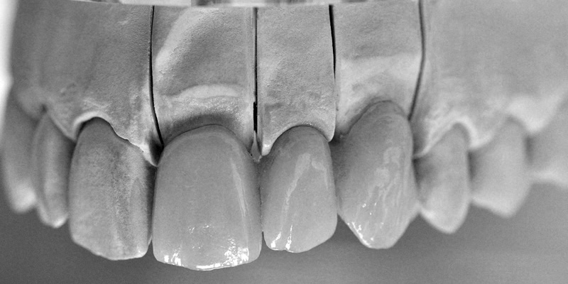 All ceramic - Emax crowns, inlays, onlays, veneers