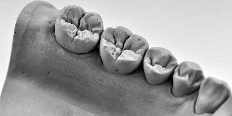 Composite crowns, inlays, onlays & composite fused to metal