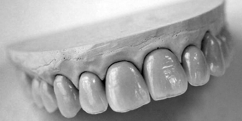 Porcelain fused to metal (precious and non-precious)