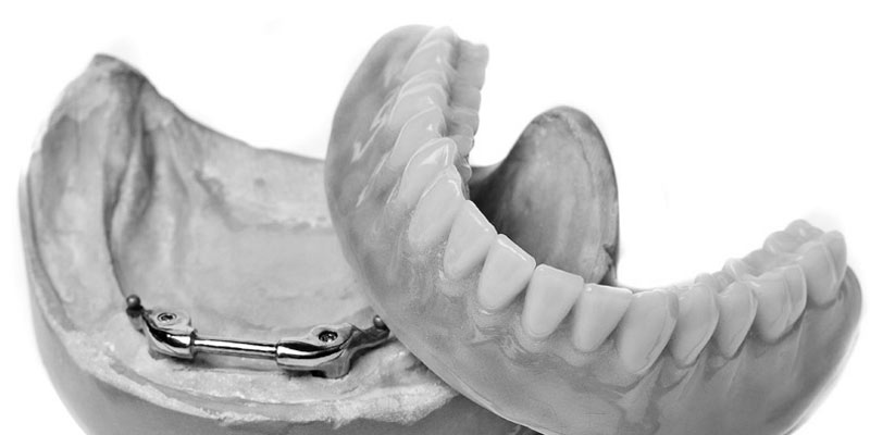 IMPLANTS