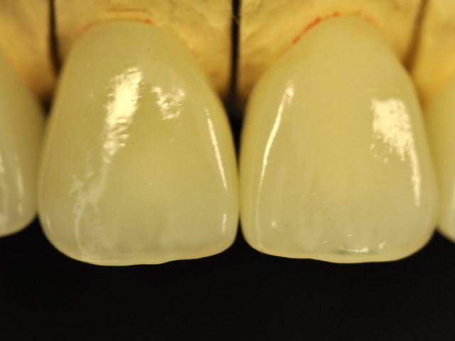 Emax crowns