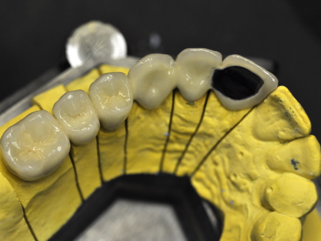 Porcelain bonded bridge