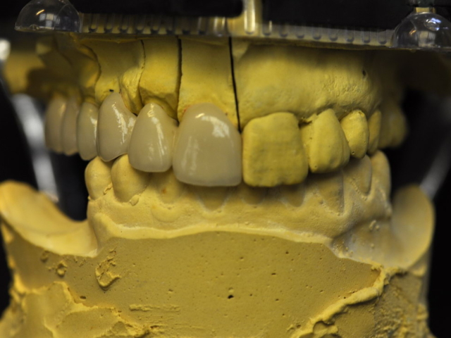 Porcelain bonded bridge