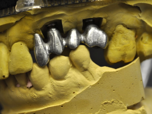 Metal framework on implants