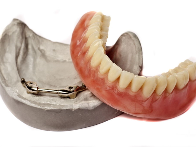 Implant denture based on 2 implant bar