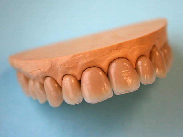Full arch porcelain bonded crowns
