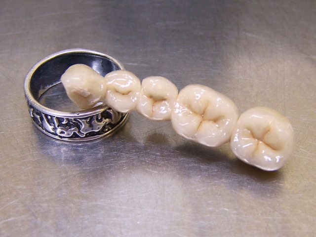 Porcelain bonded bridge