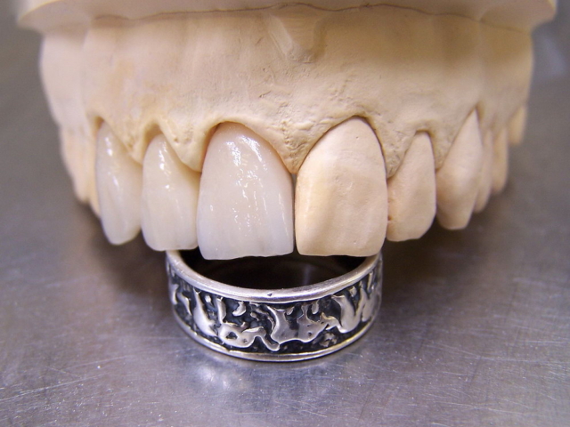 Zirconia bridge