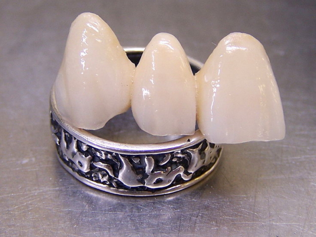 Zirconia bridge