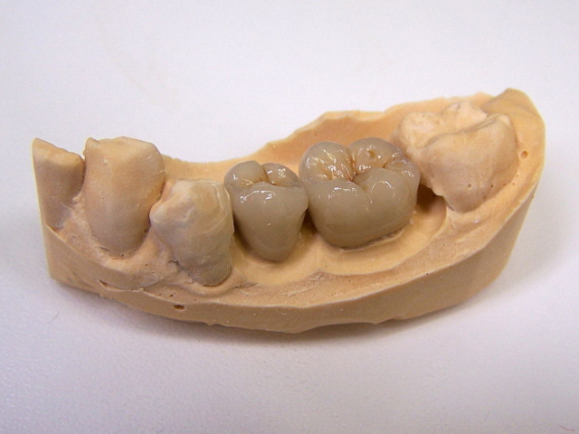Porcelain bonded crowns