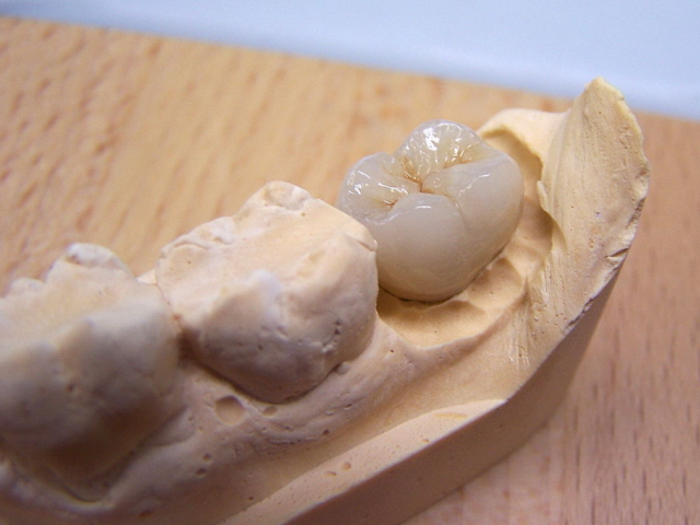 Porcelain bonded crown