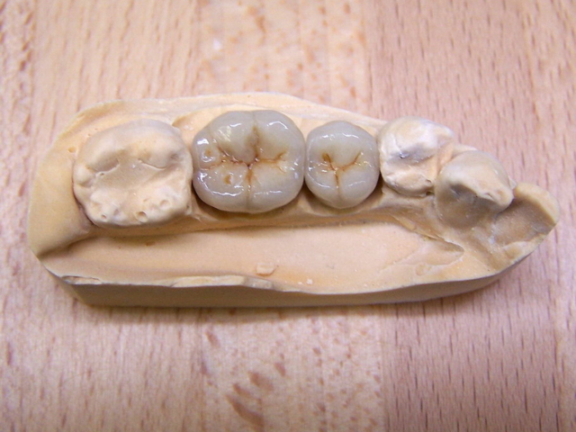 Porcelain bonded crowns