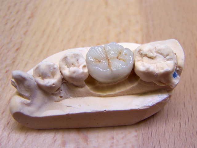 Porcelain bonded crown