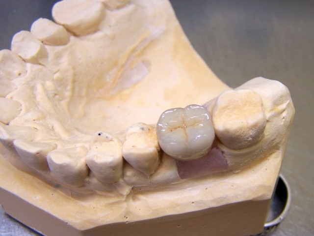 Porcelain bonded crown on implant
