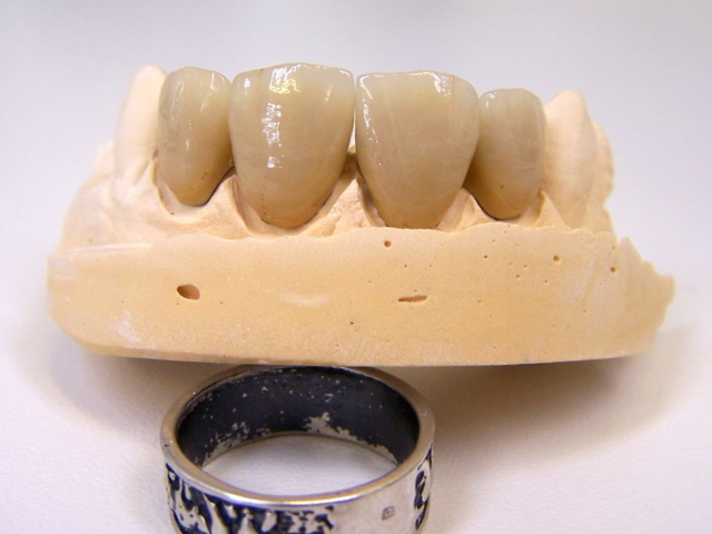 Porcelain bonded crowns